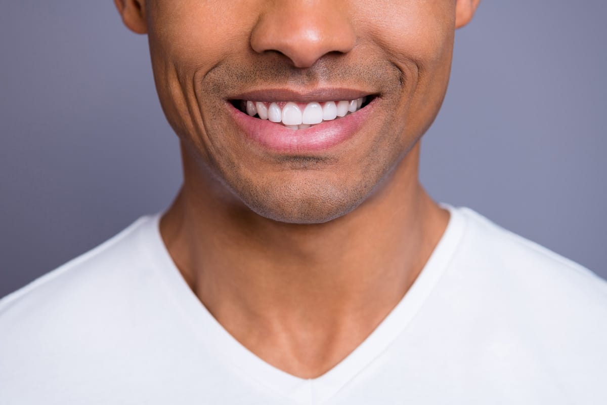 Veneers in Caterham
